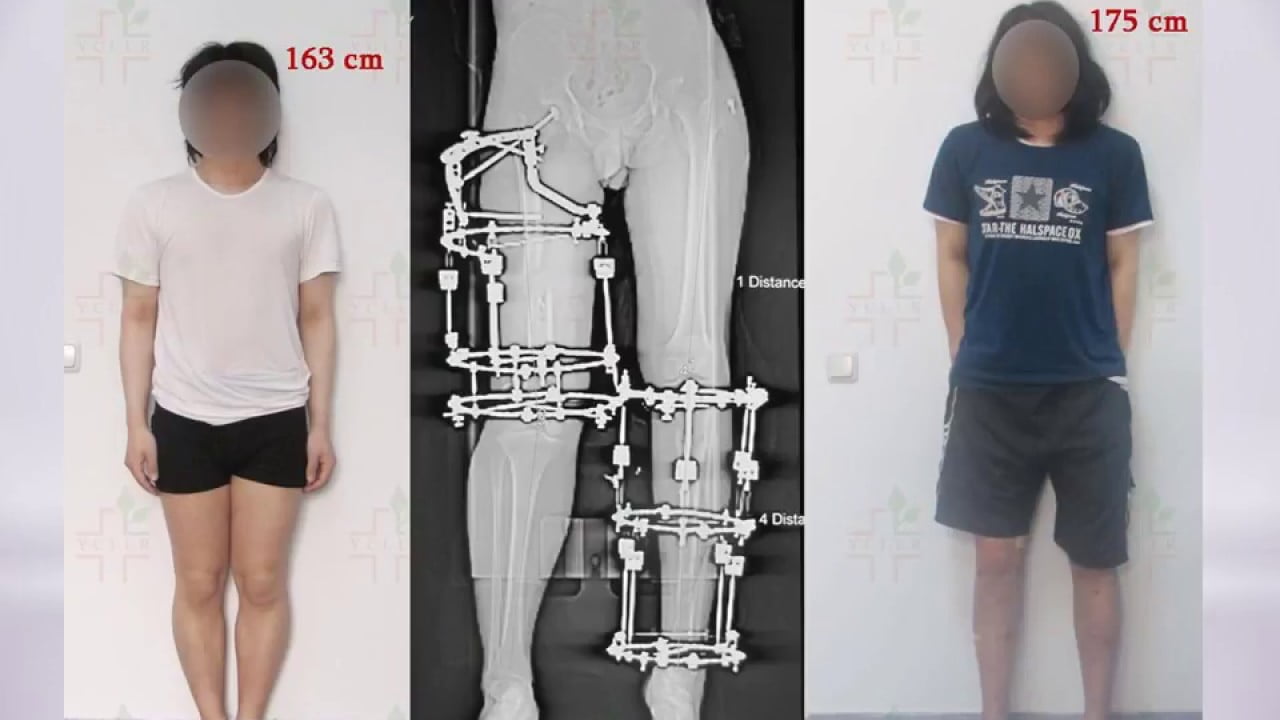 ELONGATION OF SHIN BONES SURGERY (10 CMS BILATERAL)