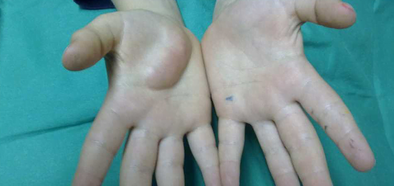 cancer and sarcoma