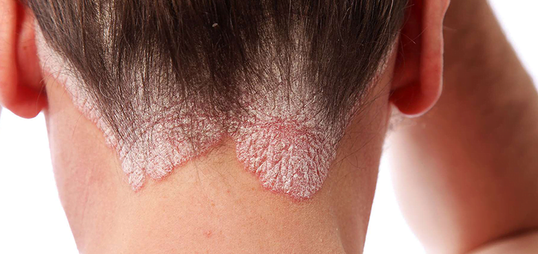 Treatment of psoriasis