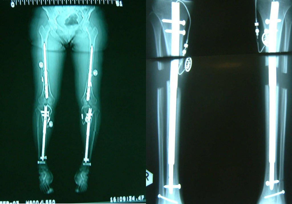 Limb Lengthening Surgery 10cm CubaHeal Medical Center limb-lengthening-surgery-10cm-cubaheal-medical-center