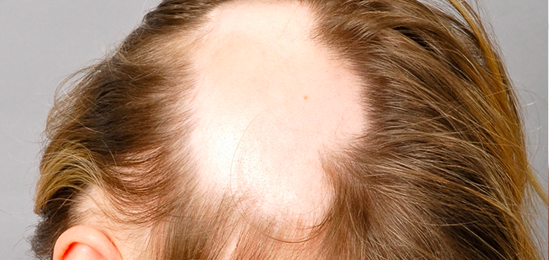 Alopecia Alopecia Areata
